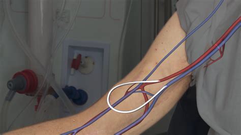 Video Qu Es Un Injerto Arteriovenoso Para Hemodi Lisis