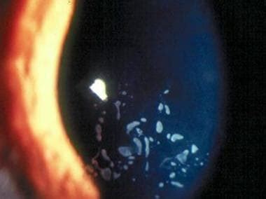 Recurrent Corneal Erosion Background Pathophysiology Epidemiology