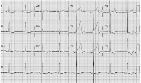 Aortic Stenosis Murmur