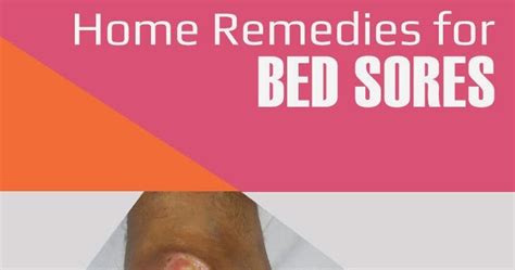 Home Remedies For Bed Sores Tips Park