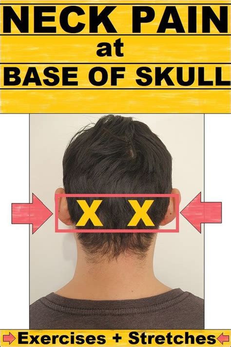 Neck pain at base of the skull – Artofit