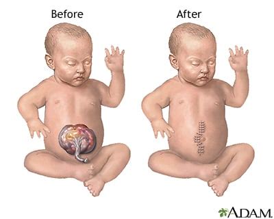 Omphalocele Repair - RNpedia