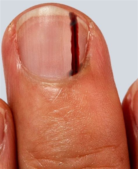 Melanoma Under Nail Bed Photos Bios Pics