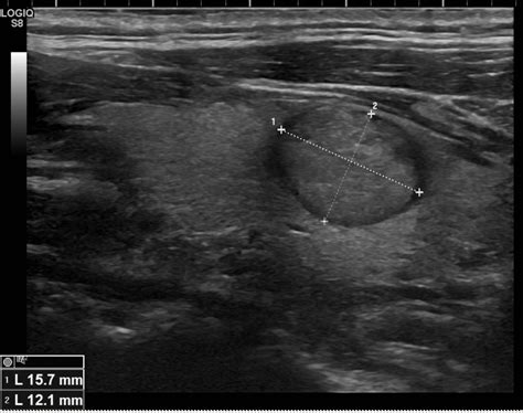 Classification Eu Tirads Toulouse Thyroide