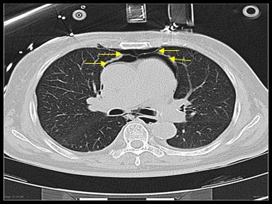 Mediastinal mass differential diagnosis - wikidoc