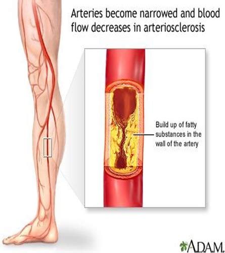 Arterial And Venous Disorders Flashcards Quizlet