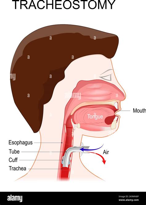 Tracheotomy Side View Of The Neck And The Correct Placement Of A