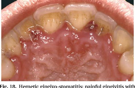 Acute Periodontal Lesions Semantic Scholar