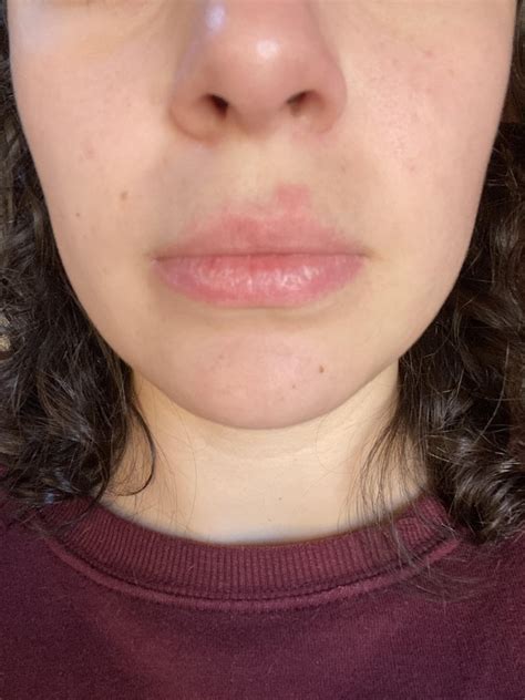 F23 Recurring Red Patch Above My Lip History Of Eczema But Never Had It On My Face R