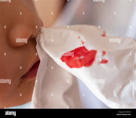 Nose Bleeding High Resolution Stock Photography and Images - Alamy