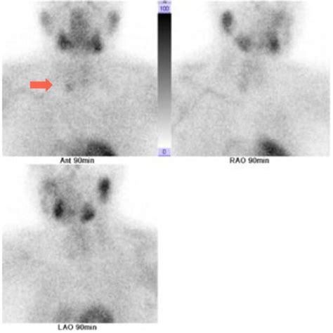 Sestamibi Scan Showing Tracer Uptake In The Lower Right Parathyroid