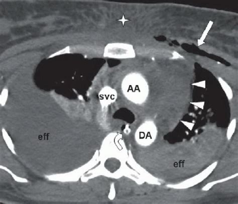 Acute Aortic Intramural Hematoma | Radiology Key