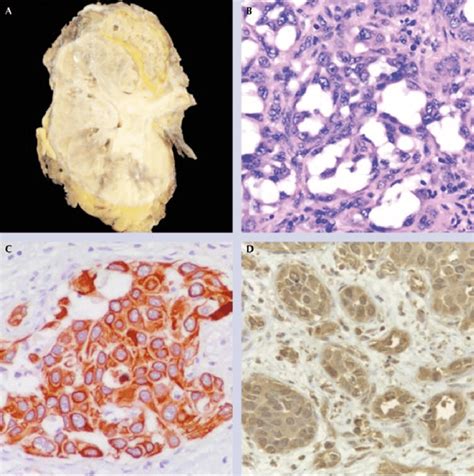 Estudio histopatológico Imagen macroscópica del tumor A tinción con