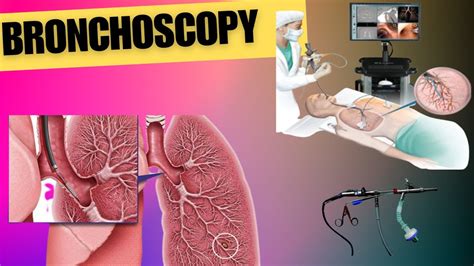 Understanding Bronchoscopy And Its Benefits Bronchoscopy Procedure