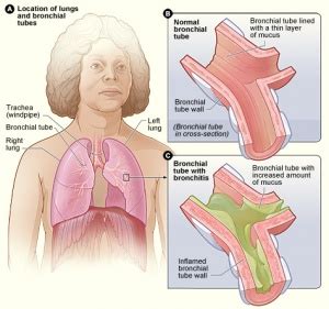 Chronic Bronchitis - Physiopedia