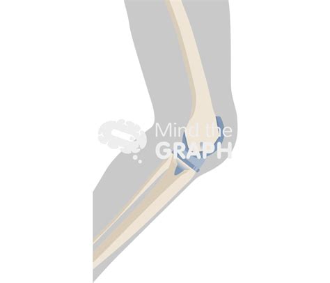 Total Knee Arthroplasty Cruciate Retaining Body