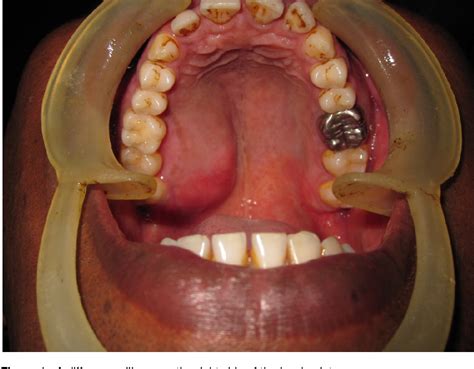 PDF Beningn Pleomorphic Adenoma Of Minor Salivary Gland Of Palate