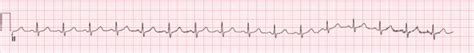 How To Read An Ecg Interpretation And Components Lecturio Medical