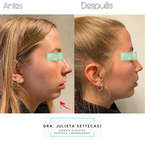 Mentoplastia Antes Y Despu S Esteticas Ar Esteticas Ar