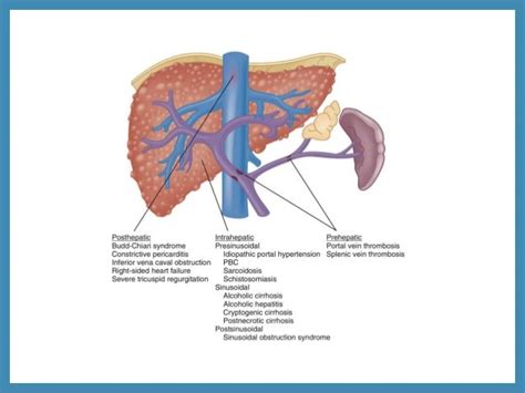 Portal Hypertension Liver Cirrhosis