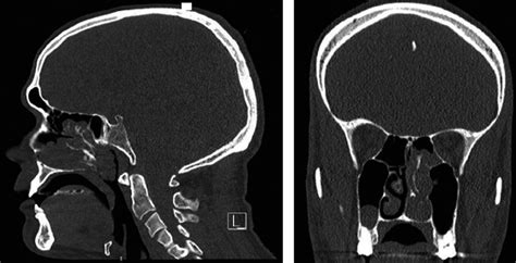 Nasal Polyps With Osseous Metaplasia A Misunderstood Situation Mat 2020 Clinical Case