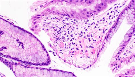 Pathology Outlines Gastric Antral Vascular Ectasia