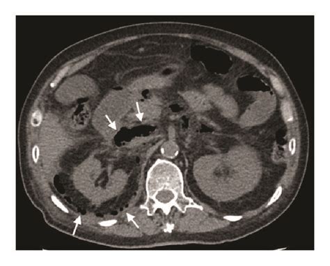 Ct Scan Of Abdomen Showing Pneumoperitoneum At Region Of 2nd And 3rd