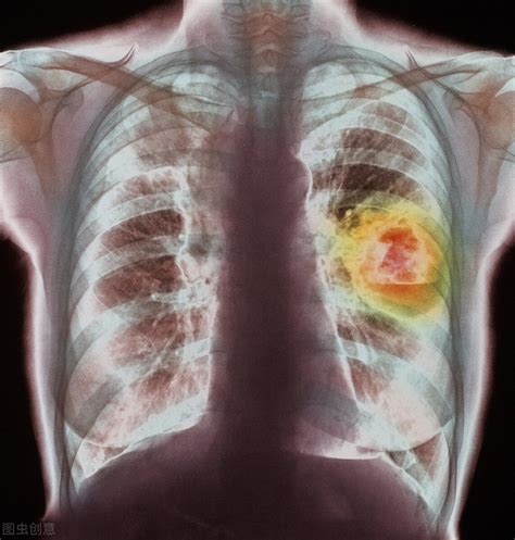 How Long Can Patients With Advanced Lung Cancer Live You Can Try This