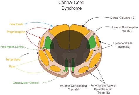 Spinal Shock Differentiation From Neurogenic Shock And Key Management