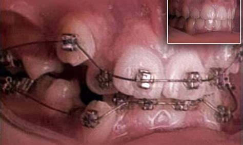 Crooked Teeth Braces Time Lapse At Sidney Thompson Blog