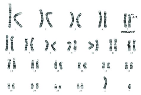 Deletion Karyotype