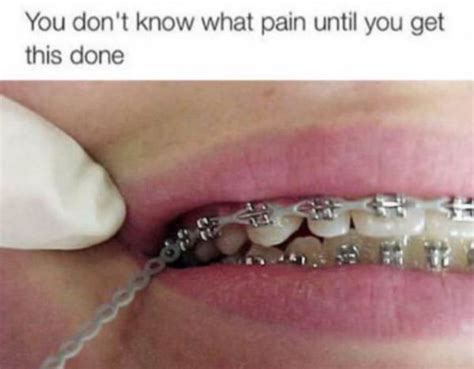 The Unstoppable Agony Of Getting A Power Chain Cute Braces Getting