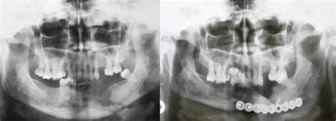 Figure 5 From Osteoradionecrosis Of The Jaws After Radiotherapy