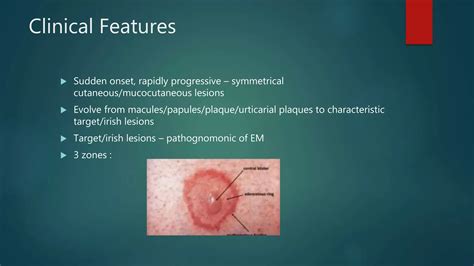 Erythema Multiforme Ppt