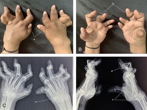 Telescoping Of Fingers JCR Journal Of Clinical Rheumatology