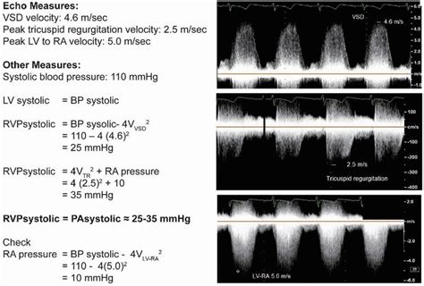 Escolta Fantasma Pioneiro Calculo Psap Ecocardiograma Fr Gil