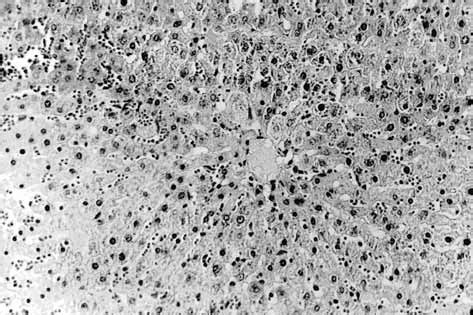 Hepatocellular Oedema Prominent In Pericentral Area Focal Necrosis