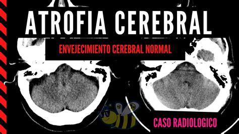 ATROFIA CEREBRAL Envejecimiento Cerebral Normal YouTube