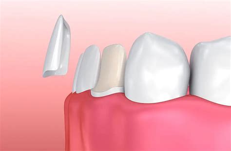 The Importance Of Dental Crowns After Root Canals Dentist Dallas Tx