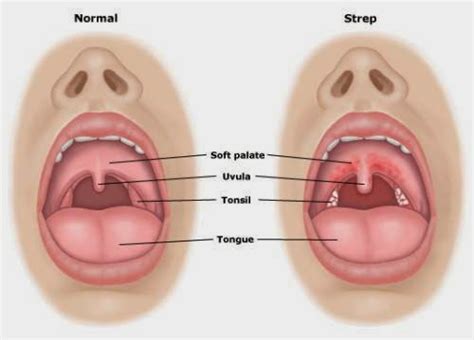 Gejala Radang Tenggorokan Dan Cara Mengatasinya Pasien Sehat