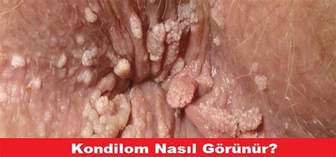 Kondilom Makat ve Genital Siğili Nedir Neden Olur Ankara Proktoloji