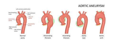 Aortic Surgery Adelaide Cardiothoracic