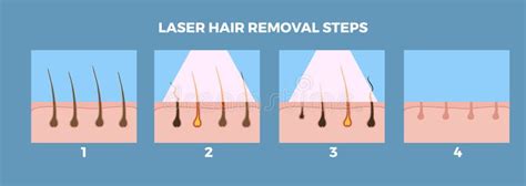 Laser Hair Removal And Depilation Steps Infographic Banner Vector Illustration Stock Vector