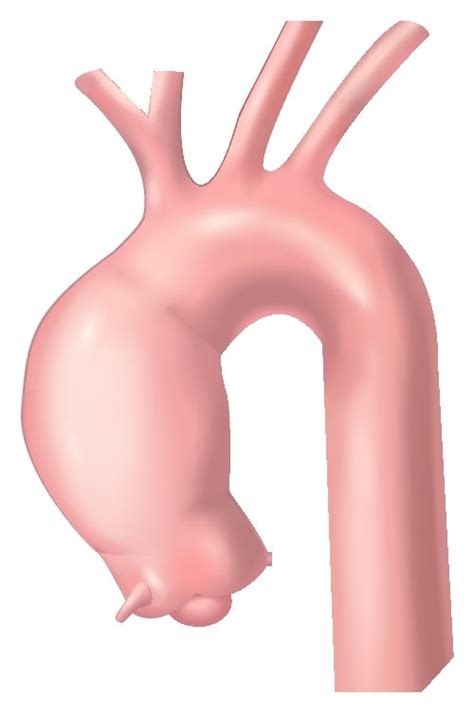 Various Techniques For Unilateral And Bilateral Antegrade Cerebral