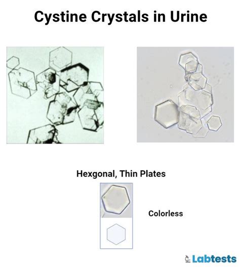 Urinary Crystals Types Causes And Clinical Significance