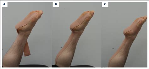 Figure 1 From Effect Of Dynamic Taping Versus Kinesiology Taping On