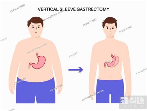 Vertical Sleeve Gastrectomy Anatomical Poster Before And After Laparoscopy Stock Vector