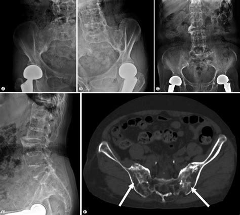 Sacroiliac Joint Dysfunction X Ray