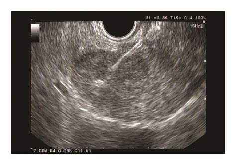 Fine Needle Aspiration During Endoscopic Ultrasound Download Scientific Diagram