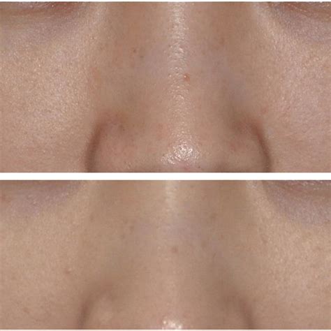 Clinical Pictures Of A Subject With Horis Nevus With Blue Brown